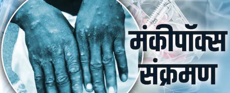 BIG BREAKING: कोरोना के बढ़ते मामले, अब मंकी पॉक्स को लेकर सरकार ने जारी किया अलर्ट, जाने MP में क्या है स्थिति, पढ़े खबर