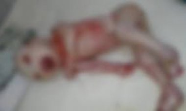 OMG : रतलाम में जन्मा कोलोडियन बेबी,एलियन सी शक्ल,ओर कुछ अंग भी विचित्र, जिसे देख सब है हैरान,पढ़े ये खबर