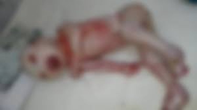 OMG : रतलाम में जन्मा कोलोडियन बेबी,एलियन सी शक्ल,ओर कुछ अंग भी विचित्र, जिसे देख सब है हैरान,पढ़े ये खबर