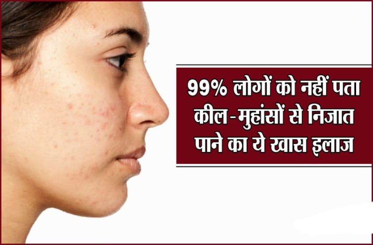 HEALTH TIPS : क्या आप भी एक्ने और मुहासे से है परेशान, तो अपनाये यह 5 नुस्के, जल्द मिलेगा इनसे छुटकारा, आइये जानते है कोनसे है वे 5 फॉर्मूले, पढ़े इस खबर में